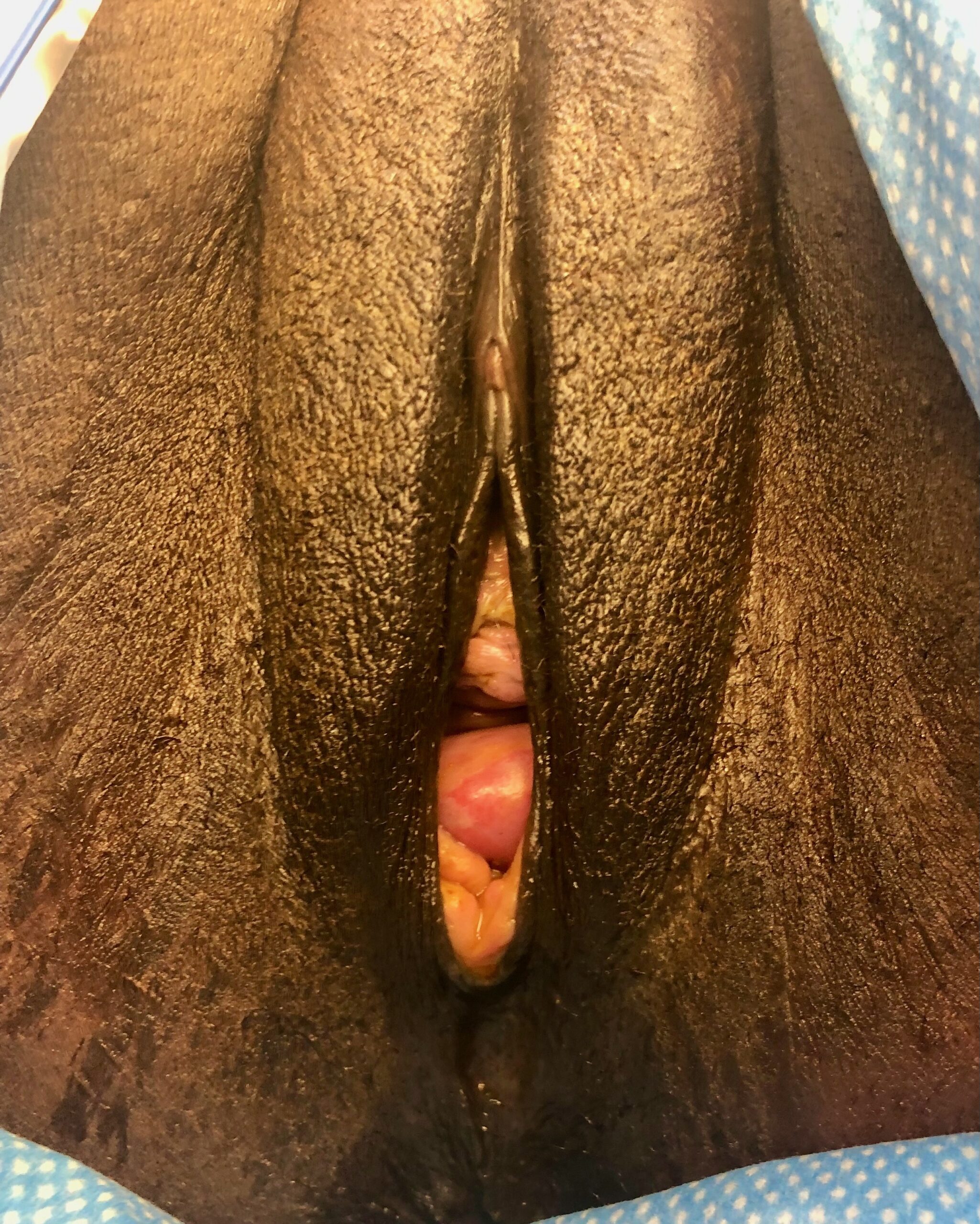 Vaginoplasty 10 Before