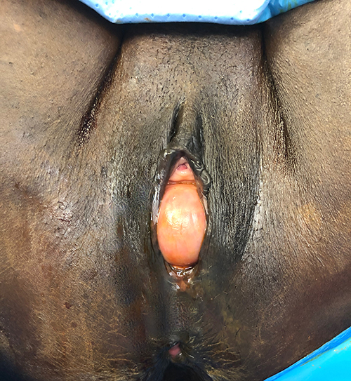 Prolapse-26 Before