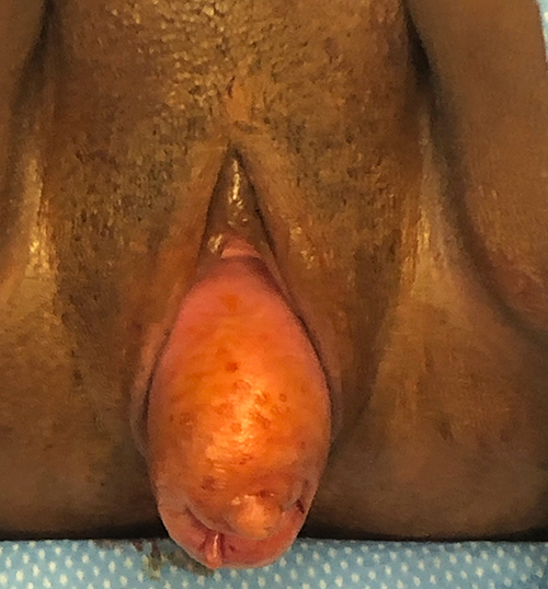 Prolapse-37 Before