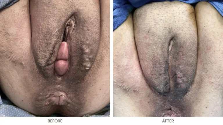 Pelvic Organ Prolapse