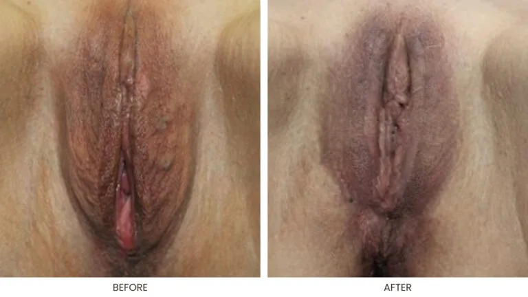 Labia Majoraplasty