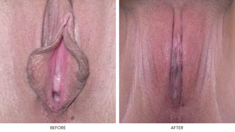 Labia Minoraplasty